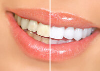 teeth whitening in Sterling Heights, MI before and after results